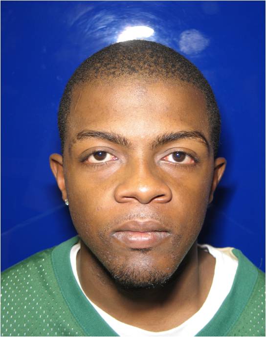 Before and After Pictures of Jaw Surgery Oral Surgery Boca & Delray