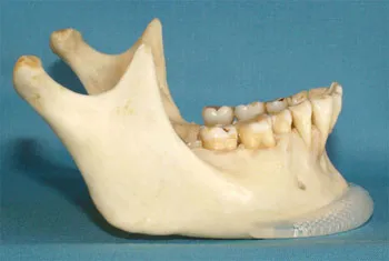 Chin Surgery model provided by Boca Raton oral surgeon Dr. Ronald Katz