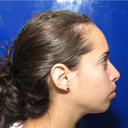 Chin Surgery case study provided by Boca Raton oral surgeon Dr. Ronald Katz