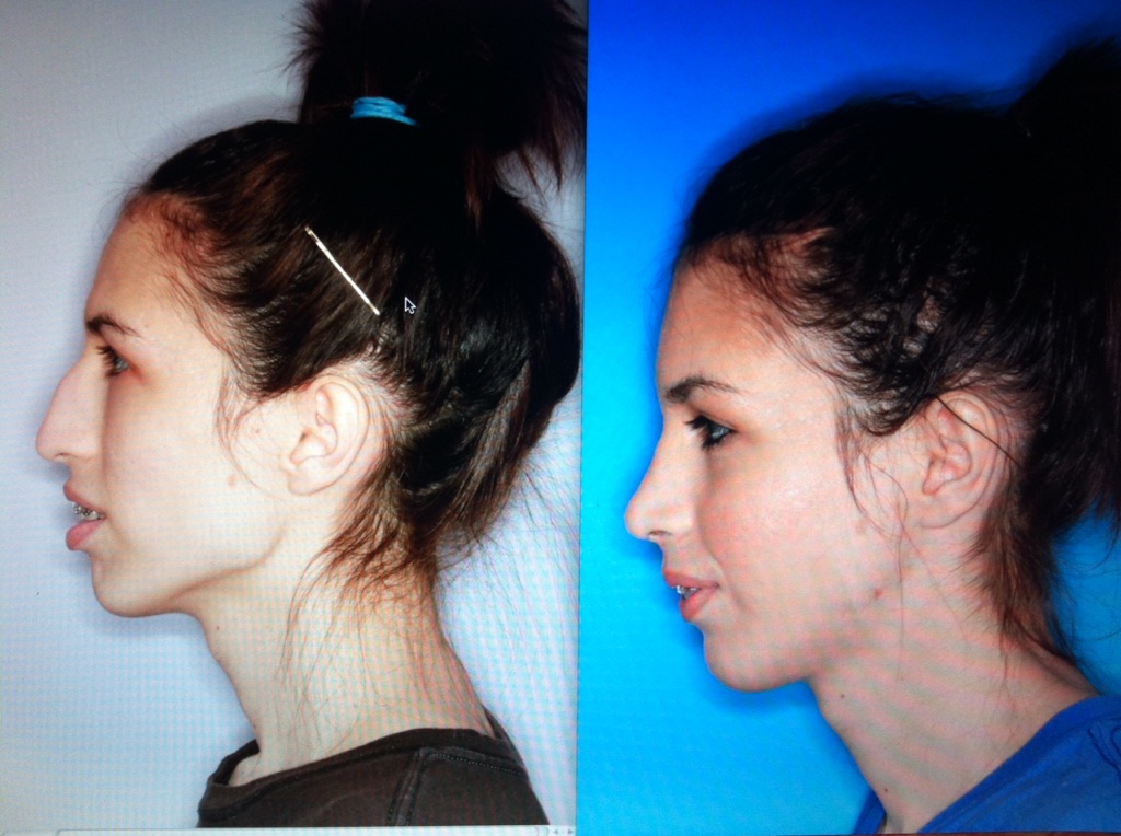 Before and After Pictures of Jaw Surgery | Oral Surgery Boca & Delray