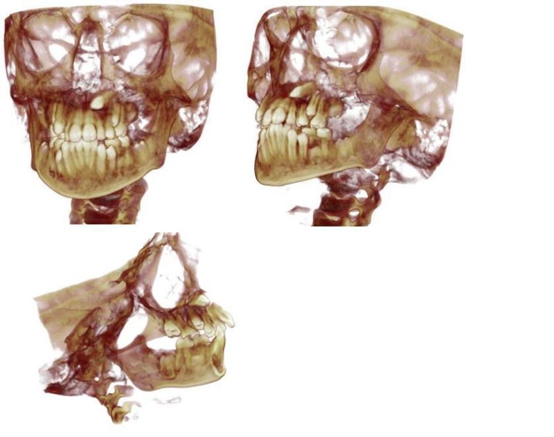 Three 3D CT scan reconstructions of a human skull showing frontal, oblique, and segmented views of the facial bones and teeth used for maxillofacial imaging and surgical planning