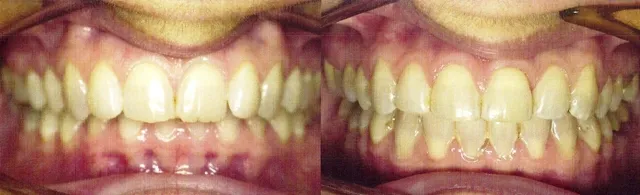 Before and after dental view showing corrected teeth positioning and bite alignment following jaw surgery