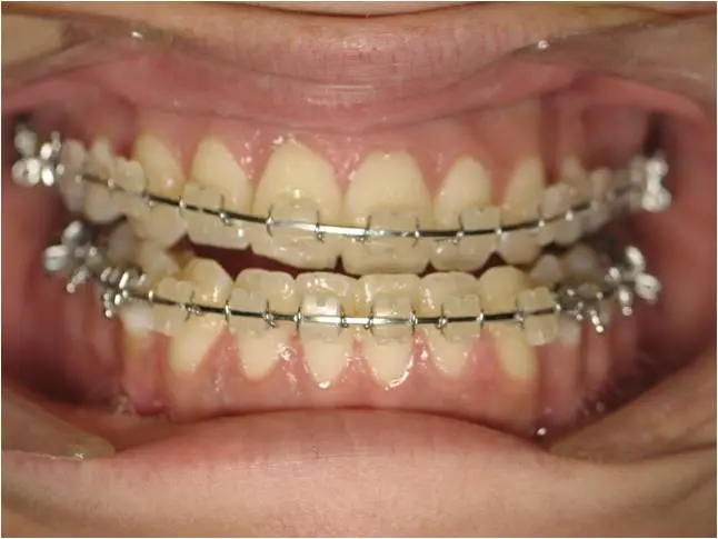 Close-up of teeth with braces before jaw surgery showing misalignment and bite issues