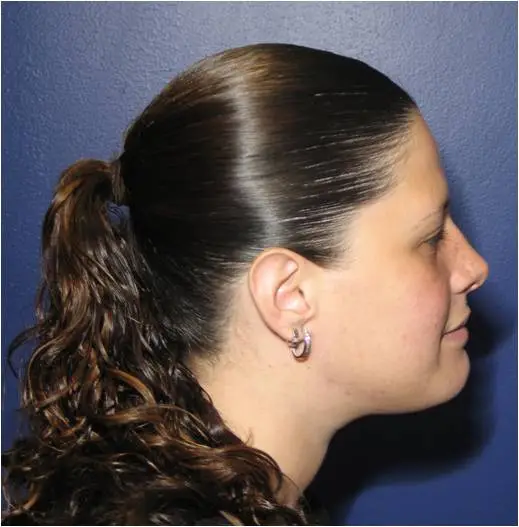 Before and After Pictures of Jaw Surgery Oral Surgery Boca & Delray