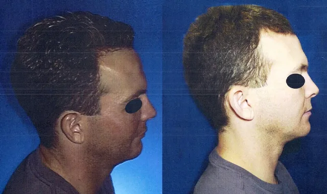Before and after profile comparison demonstrating significant correction of a recessed chin and improved jawline projection after orthognathic surgery