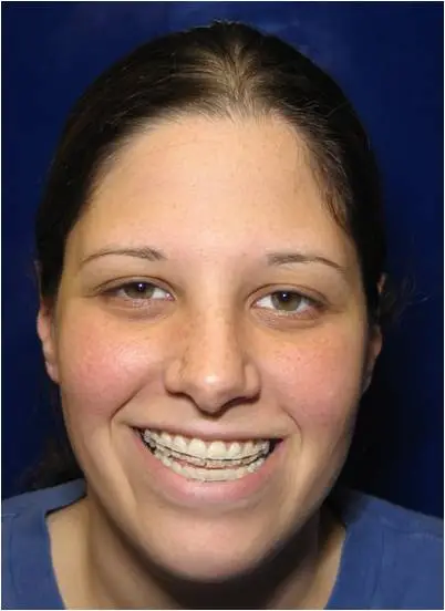 Frontal view of a female patient before jaw surgery, smiling and showing her initial facial structure and jawline