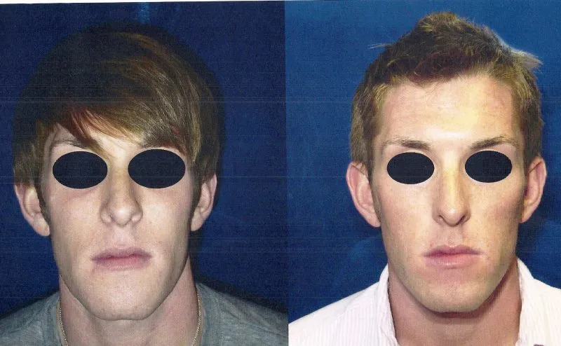 Before and after frontal photos of male patient showing improved jaw symmetry and facial balance after jaw surgery