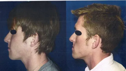 Before and after profile photos demonstrating corrected jaw position and improved chin projection after surgery