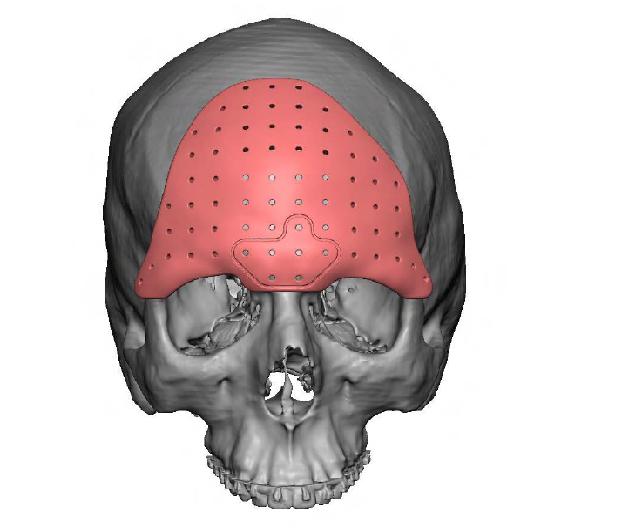 Forehead Recontouring