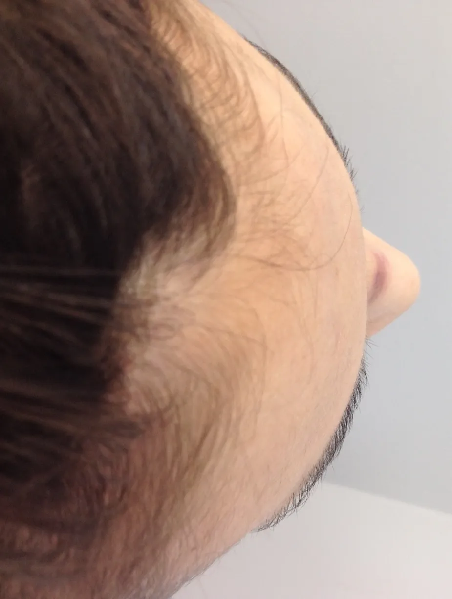 Forehead Recontouring case study