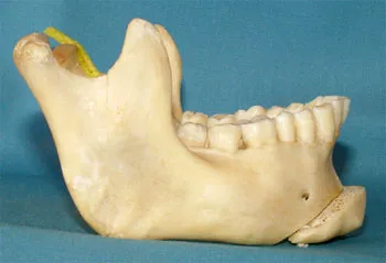 Chin Surgery model provided by Boca Raton oral surgeon Dr. Ronald Katz