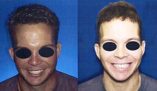 Before and after frontal photos of a male patient showing improved jaw symmetry, wider smile, and better facial balance following jaw surgery