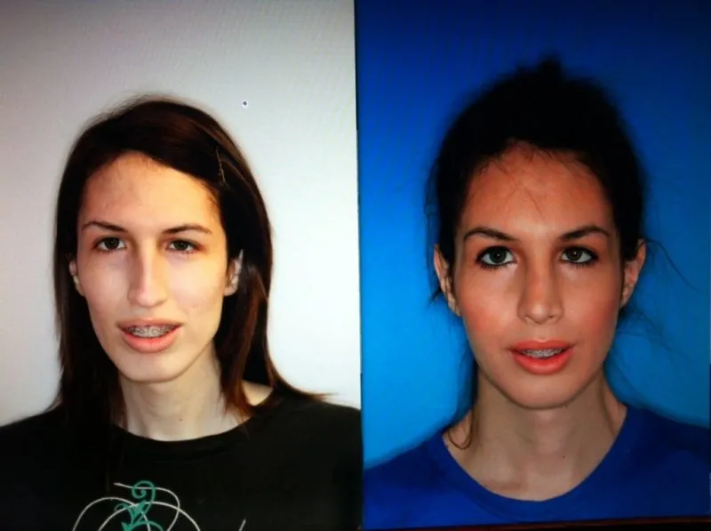 Before and after frontal photos of a woman showing improved facial balance and jaw alignment after jaw surgery