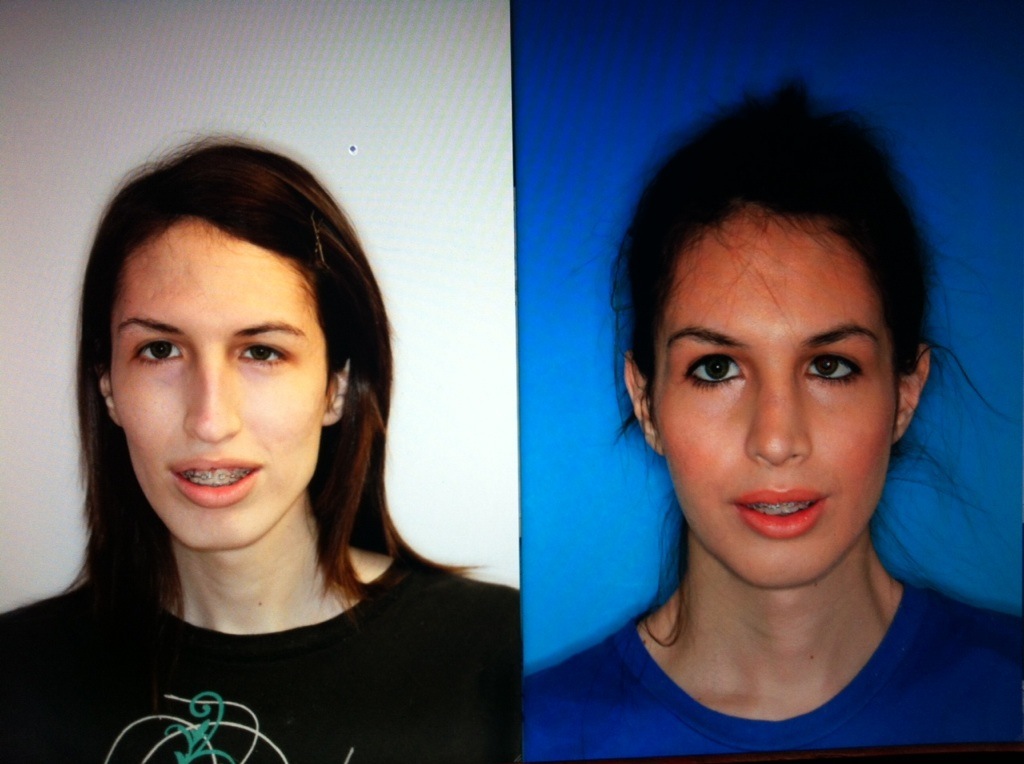 Before and After Pictures of Jaw Surgery Oral Surgery Boca & Delray
