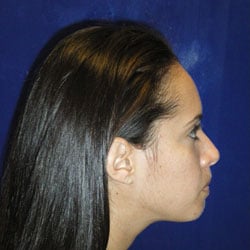 Chin Surgery case study provided by Boca Raton oral surgeon Dr. Ronald Katz