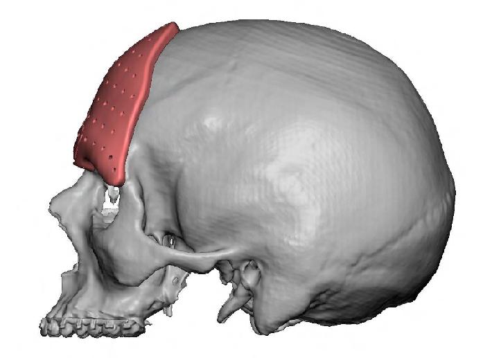 Forehead Recontouring