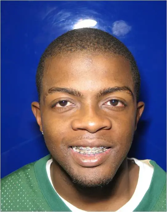 Frontal portrait of the patient after surgery smiling, displaying improved jaw symmetry and definition