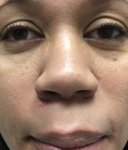 nevi and mole removal