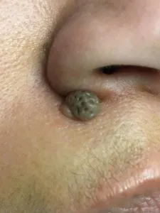 mole nevi removal