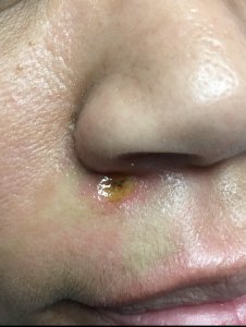 nevi mole removal
