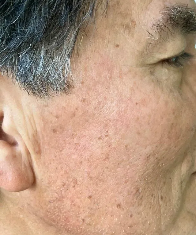mole and nevi removal