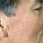 mole and nevi removal