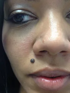 mole and  nevi removal
