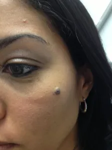 nevi removal