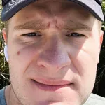 Close-up facial view showing a dark mole on the cheek area prior to treatment or removal