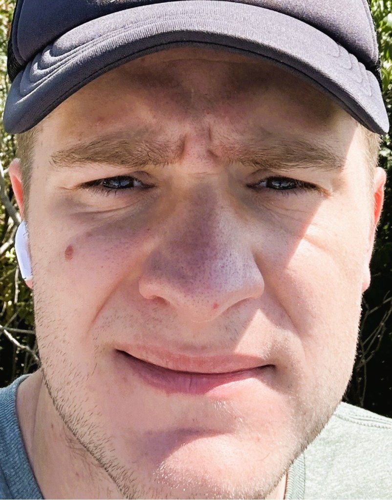 Close-up facial view showing a dark mole on the cheek area prior to treatment or removal