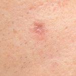 Detailed close-up view of skin showing a small raised mole or skin lesion with reddish-pink pigmentation on light-colored skin surface