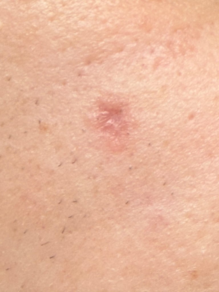 Detailed close-up view of skin showing a small raised mole or skin lesion with reddish-pink pigmentation on light-colored skin surface