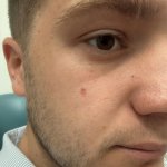 Side view close-up showing the mole or post-removal site on the facial skin during treatment progression