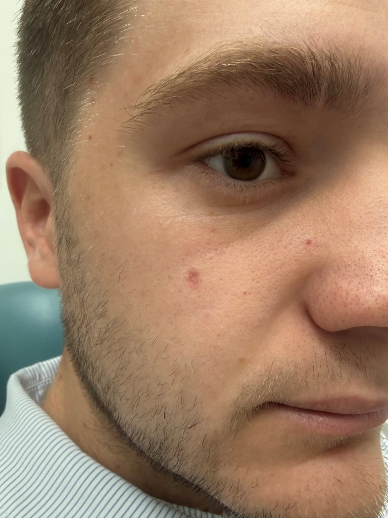 Side view close-up showing the mole or post-removal site on the facial skin during treatment progression
