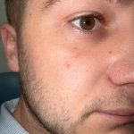 Close-up of the eye and cheek area showing a mole or pigmented spot on the facial skin
