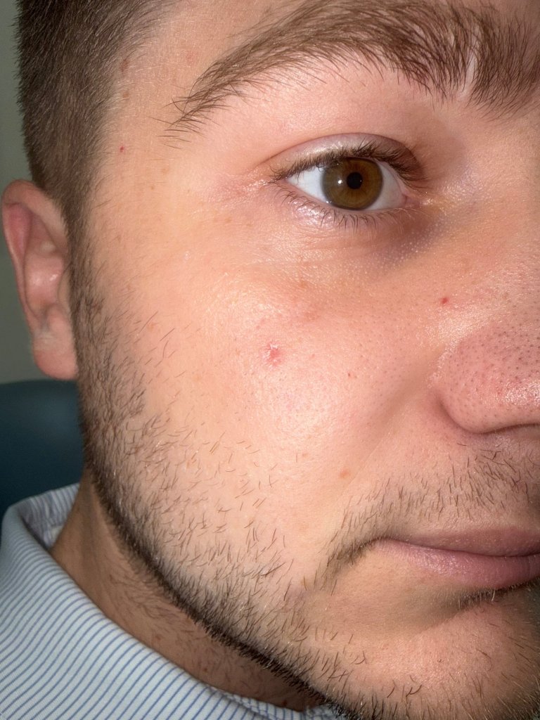 Close-up of the eye and cheek area showing a mole or pigmented spot on the facial skin