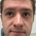 Front-facing close-up photo of a man showing his facial skin, after mole removal procedure with clear complexion visible