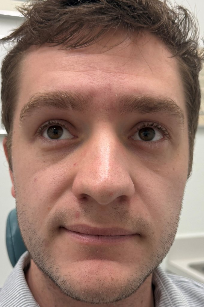 Front-facing close-up photo of a man showing his facial skin, after mole removal procedure with clear complexion visible