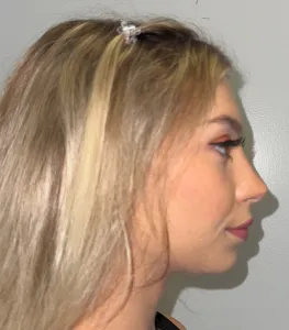 Before chin repositioning three-quarter view - sliding genioplasty Boca Raton